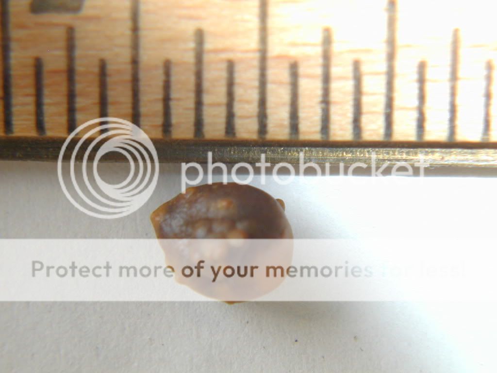 kidney stones anyone international skeptics forum